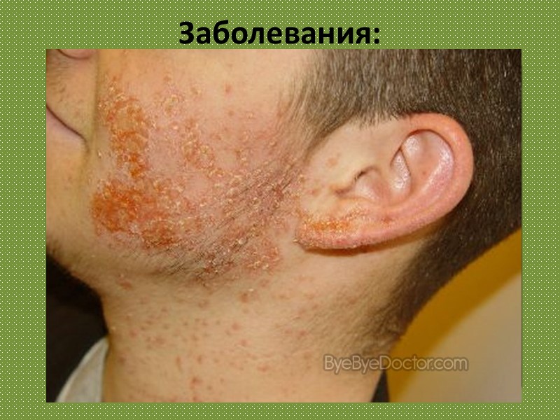 Заболевания: Стафилококк (новолат. Staphylococcus, от др.-греч. σταφυλή, «виноград» и κόκκος - «зерно») - широко